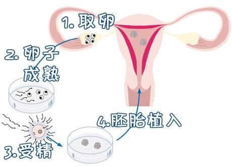 试管代怀包生捐卵公司